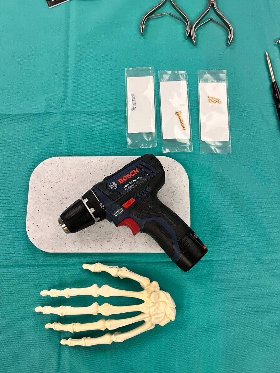 Handmodell mit Osteosynthesematerial